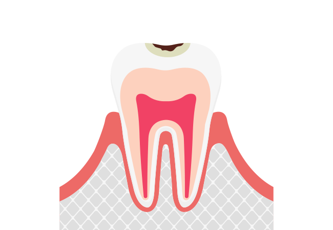 自覚症状がない初期むし歯：CO〜C1