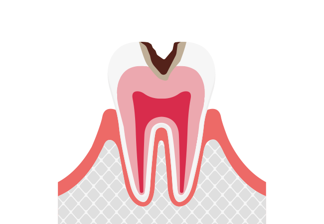 冷たいもの、甘いものがしみる：C2