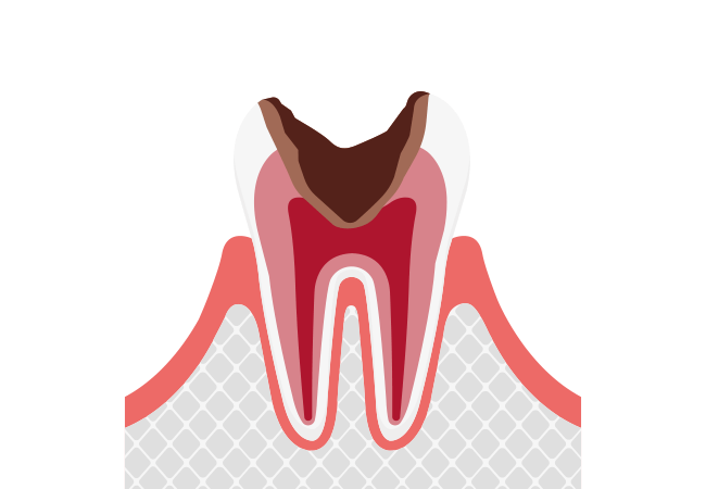 熱いものがしみる、激しい痛みがある：C3