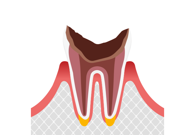 歯の根だけが残った状態（末期のむし歯）：C4