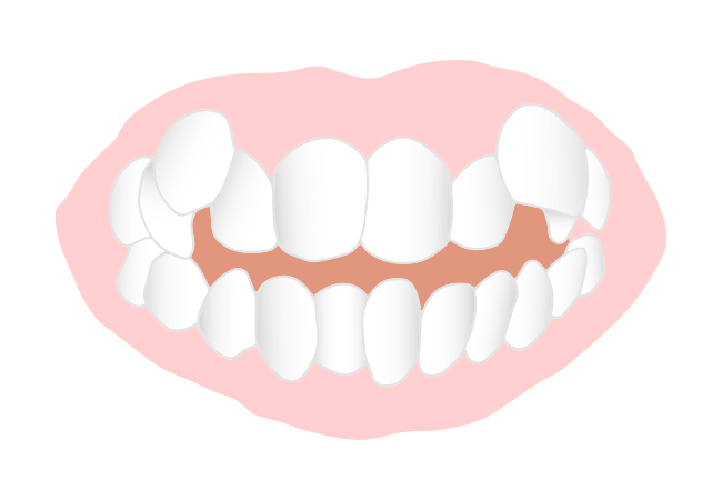 八重歯、乱ぐい歯（叢生：そうせい）