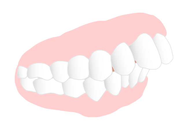 出っ歯（上顎前突：じょうがくぜんとつ）