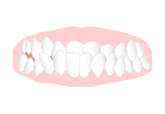 受け口（下顎前突：かがくぜんとつ）