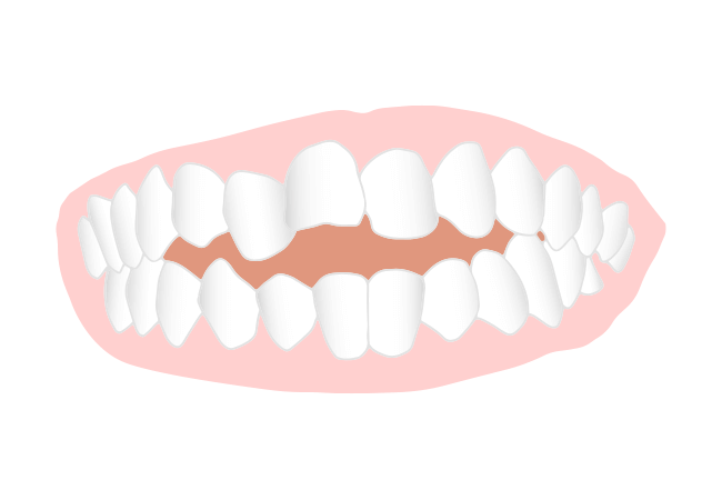 開咬（かいこう）