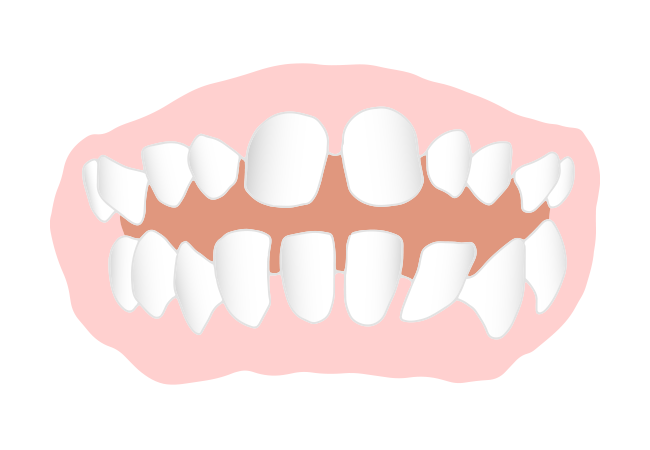 すきっ歯（空隙歯列：くうげきしれつ）