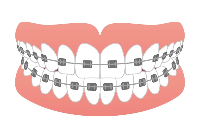 ワイヤー矯正（マルチブラケット装置）