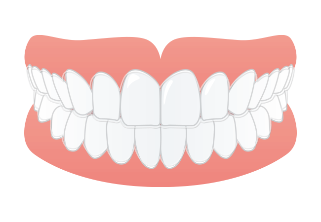 マウスピース矯正