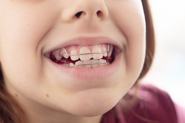 固定式矯正装置