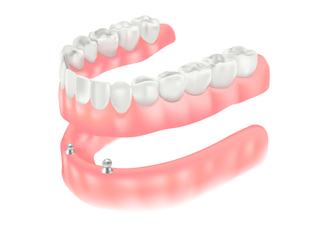 インプラントオーバーデンチャー