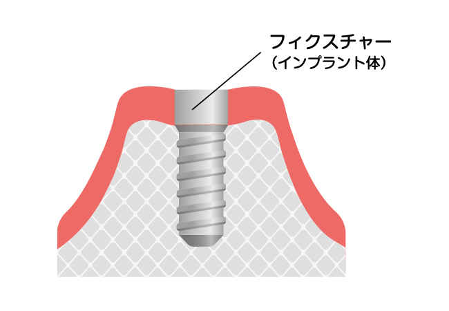人工歯根（フィクスチャー）