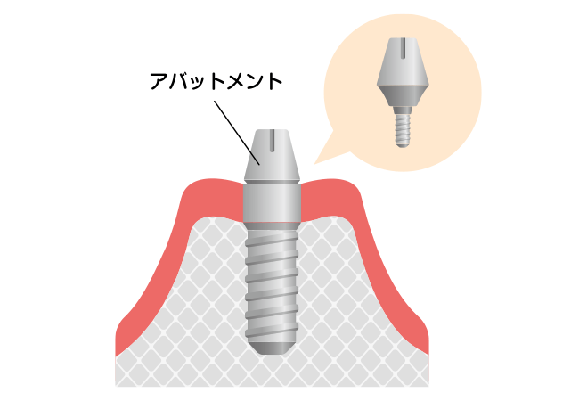 連結部（アバットメント）