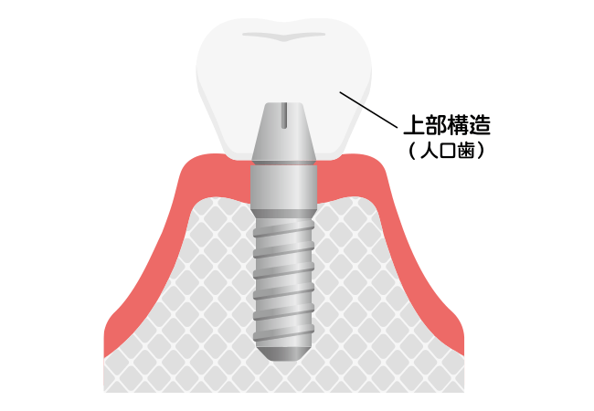 上部構造（人工歯）